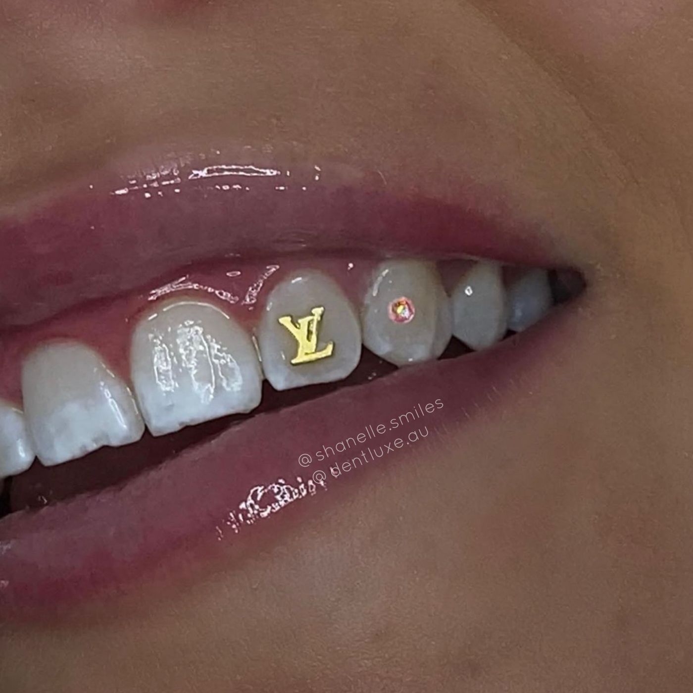 18k Gold Tooth Gem LV LOGO