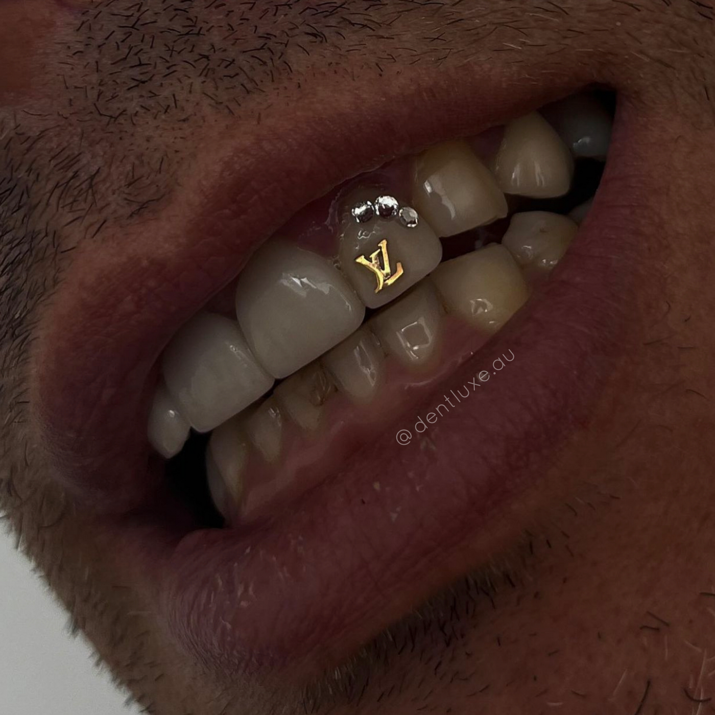 18k Gold Tooth Gem LV LOGO