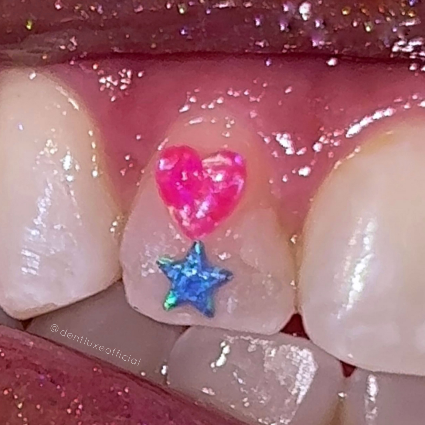 Star Opal Tooth Gems